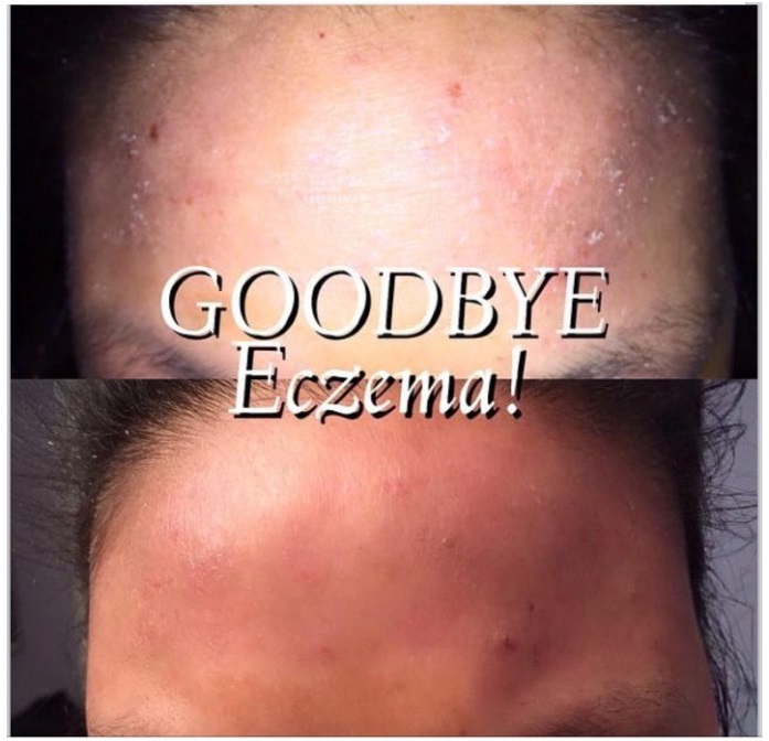 acupuncture for pain