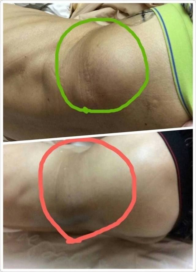 acupuncture for pain