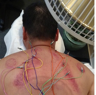 acupuncture for pain