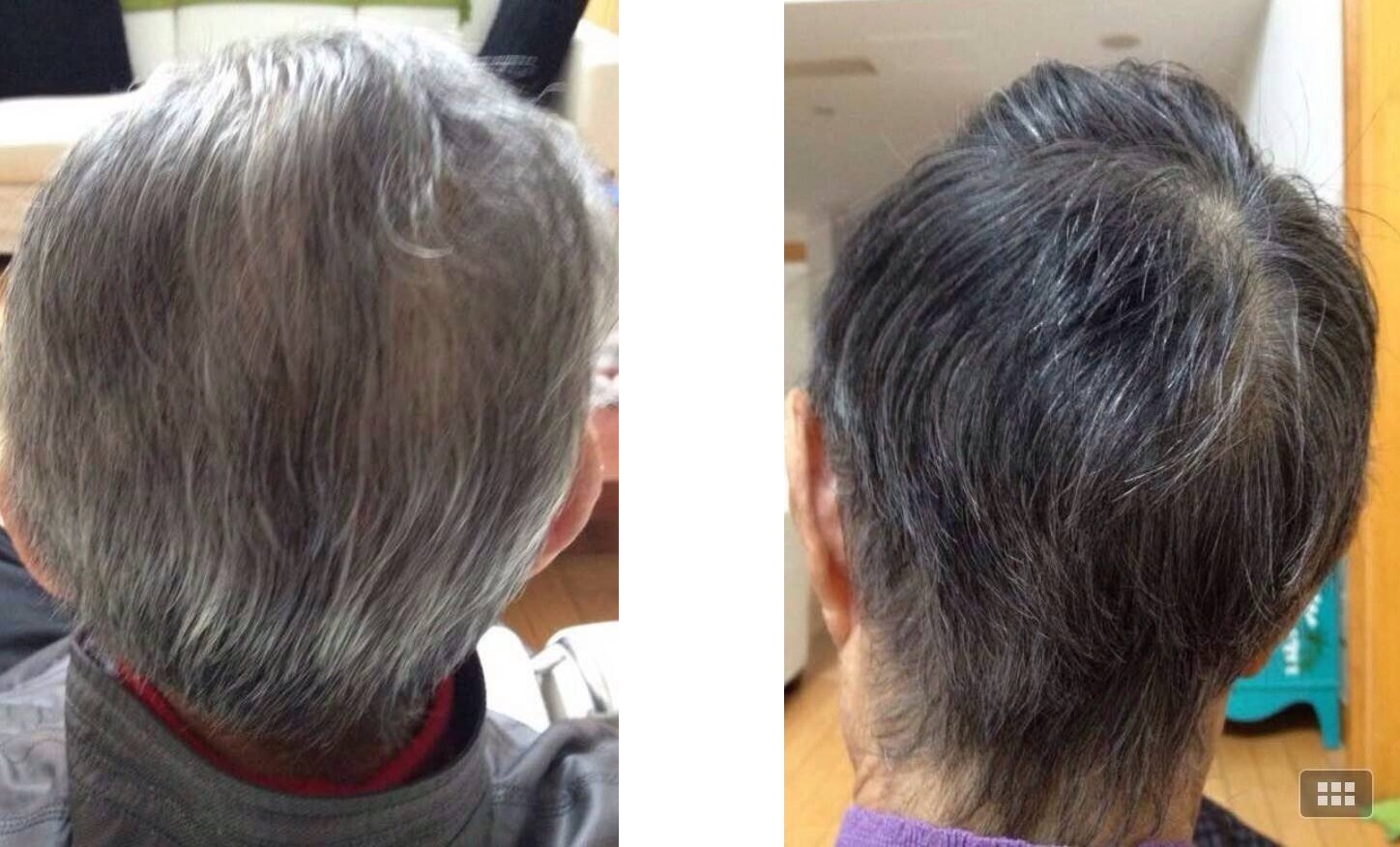 acupuncture for pain